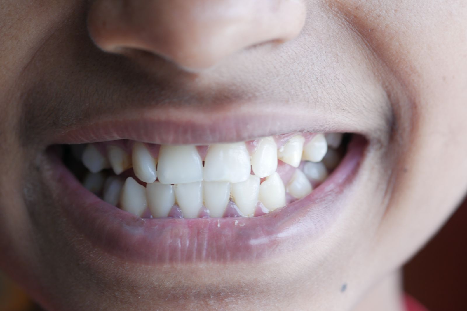 Person applying a clear teeth-whitening strip to their teeth