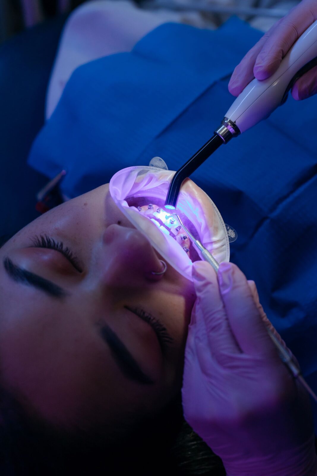 Person using an LED teeth-whitening device with a mouth tray